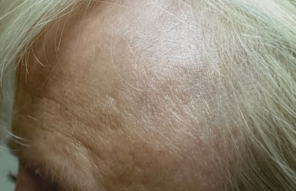 Hairvein Clinic Vein Treatment 3 Forehead After