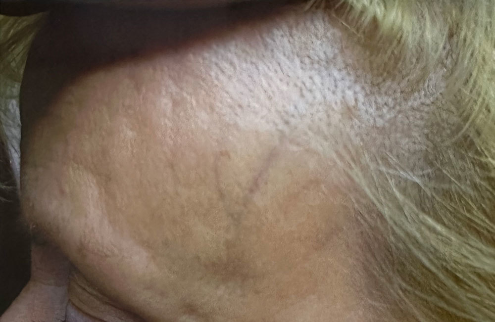 Hairvein Clinic Vein Treatment 3 Forehead Before